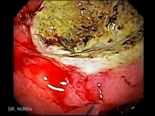 Endoscopia de Ulcera Gástrica