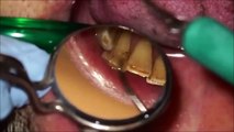 تنظيف الاسنان وإزالة الجير ........ Dental scaling