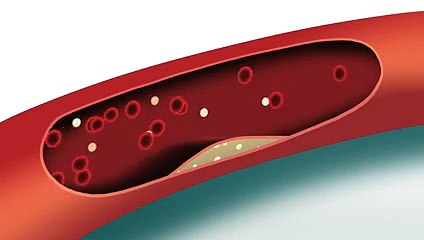 How cholesterol affects your risk of heart attack or stroke