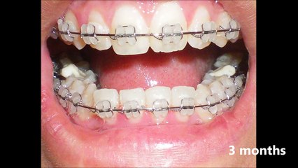 Braces time lapse, Transformation before and after