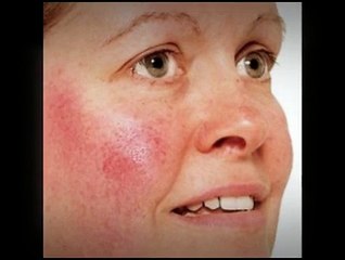 Different Types of Rosacea Symptoms