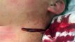 Throat slashed by Knife attack ' Warning Graphic ' before and after stitches