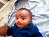 Baby with Cleft Lip and Palate