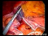 Laparoscopic Roux-en-Y Gastric Bypass Surgery