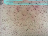 Beard hair growth on minoxidil, chin (10.1 month) time lapse