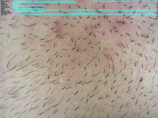 Beard hair growth on minoxidil, chin (10.1 month) time lapse