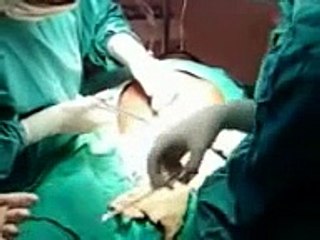 Quadruplets delivery