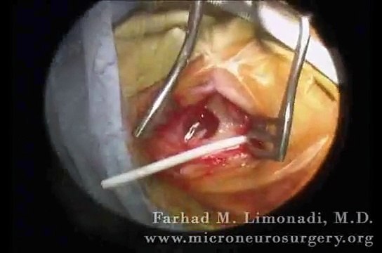 Minimally invasive brain surgery (third ventriculostomy) through a keyhole approach.