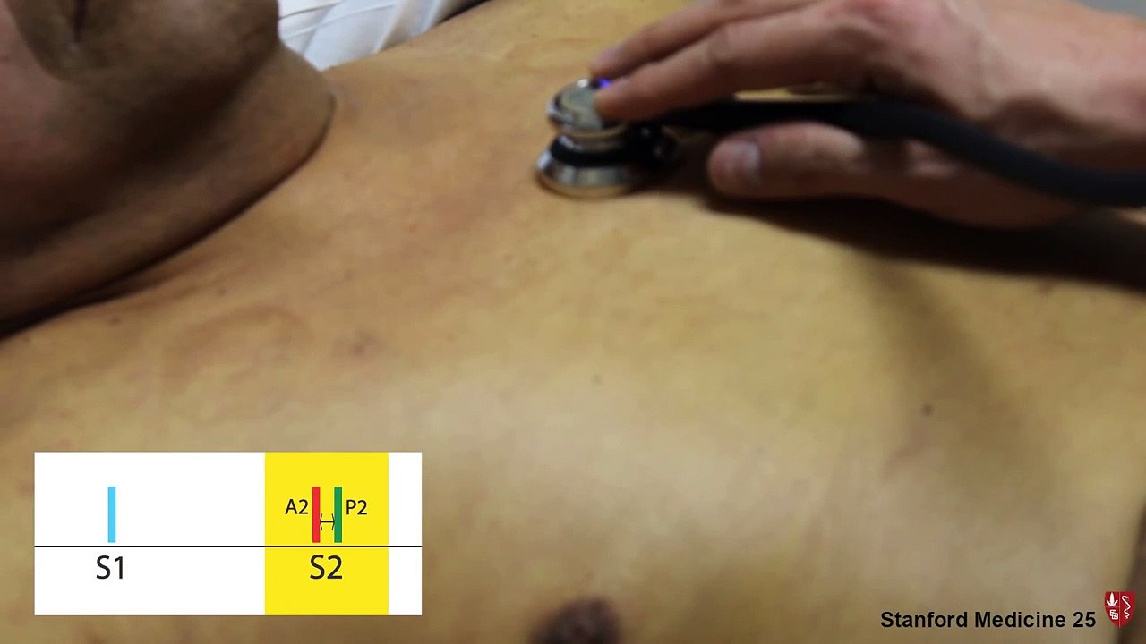 Fixed Split Second Heart Sound