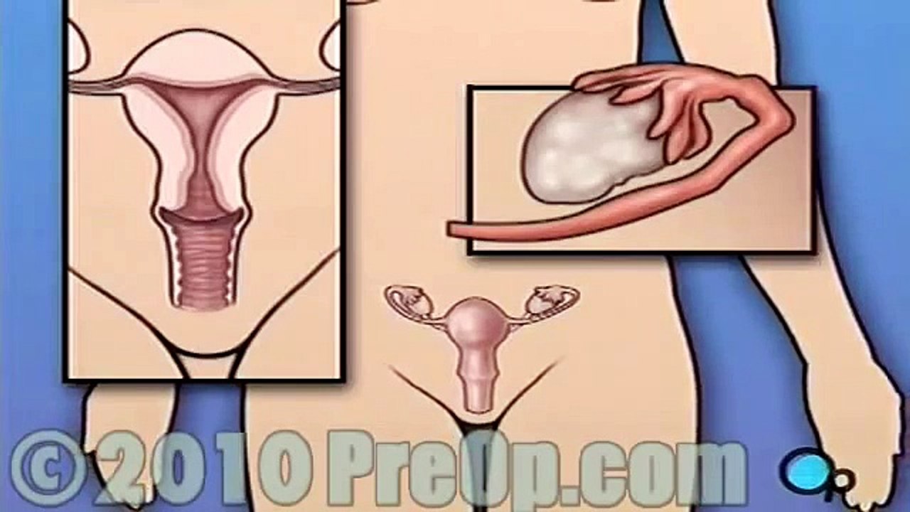 Hysterectomy Removal of the Uterus PreOp® Patient Education Feature