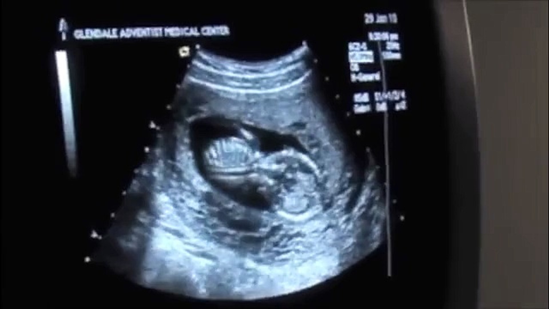 Ultrasound 14 possibly boy. video Dailymotion