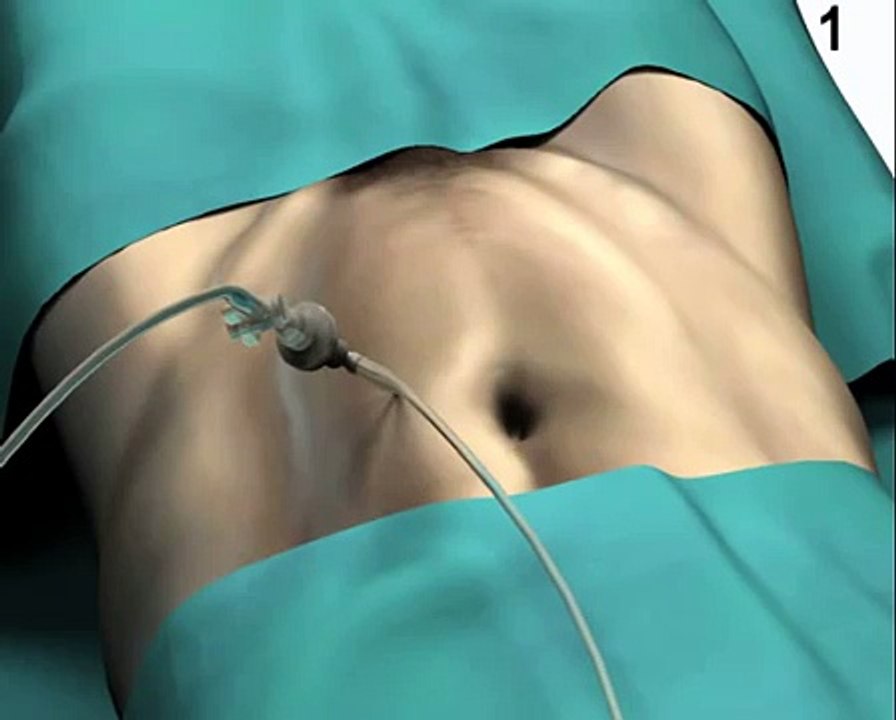 hernia operation