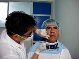 Aumento de labios, relleno de labios en hombres con acido hialuronico por Dermatologo en Lima