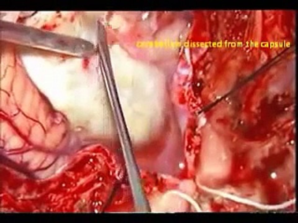 Brain tumor-CEREBELLAR DERMOID-microsurgical removal-dr suresh dugani/HUBLI/KARNATAK/INDIA