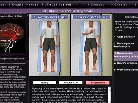 Middle cerebral artery stroke - Axiom Neuro 3D Neurology and Neuroanatomy