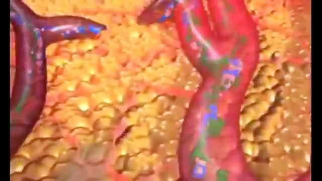 Ultrasound & Radio Frequency Fat Cavitation- How does it work