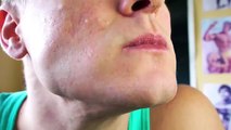 Acne Extractions | Retin-A & Accutane (Week 67)