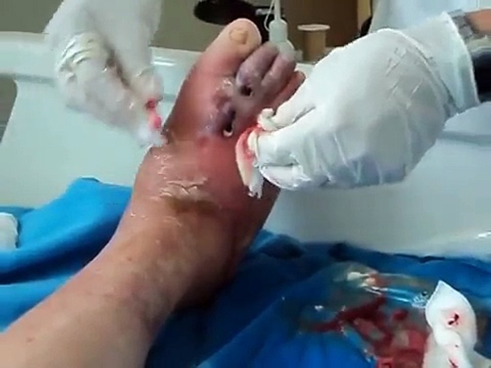 CURATIVO EM PÉ DIABÉTICO!  MOV00095