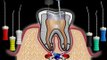 Root Canal Treatment