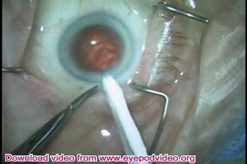 Anterior Vitrectomy & Cortex Removal During Cataract Surgery