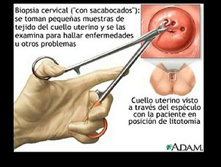 cancer del cuello uterino