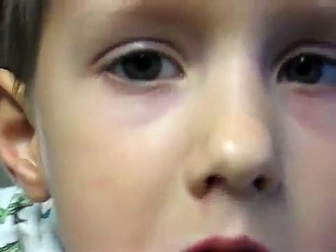Nystagmus