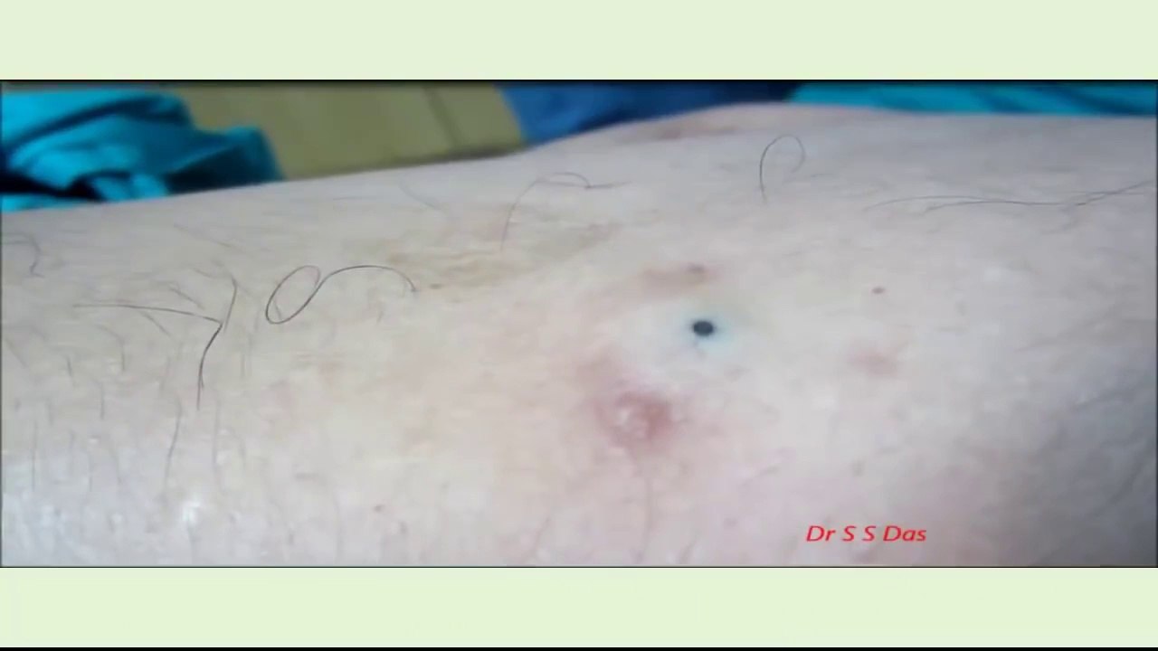 How to remove the sebaceous cyst in left arm 2015 HD I Cyst Removal
