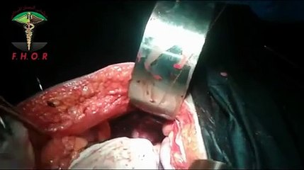 مشفى الرستن الميداني 30 6 2015 عملية جراحية فتح بطن اسعافي اصابة في الكبد مع خياطته   مصاب من الرستن