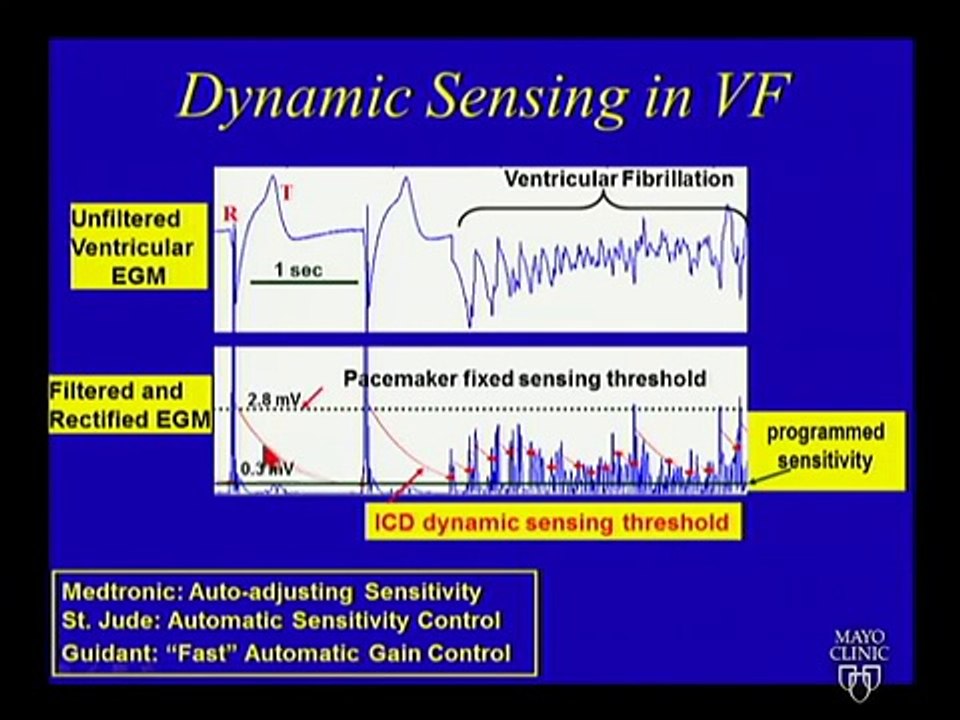 ICD Troubleshooting - Dr. Friedman, Mayo Clinic