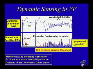 ICD Troubleshooting - Dr. Friedman, Mayo Clinic