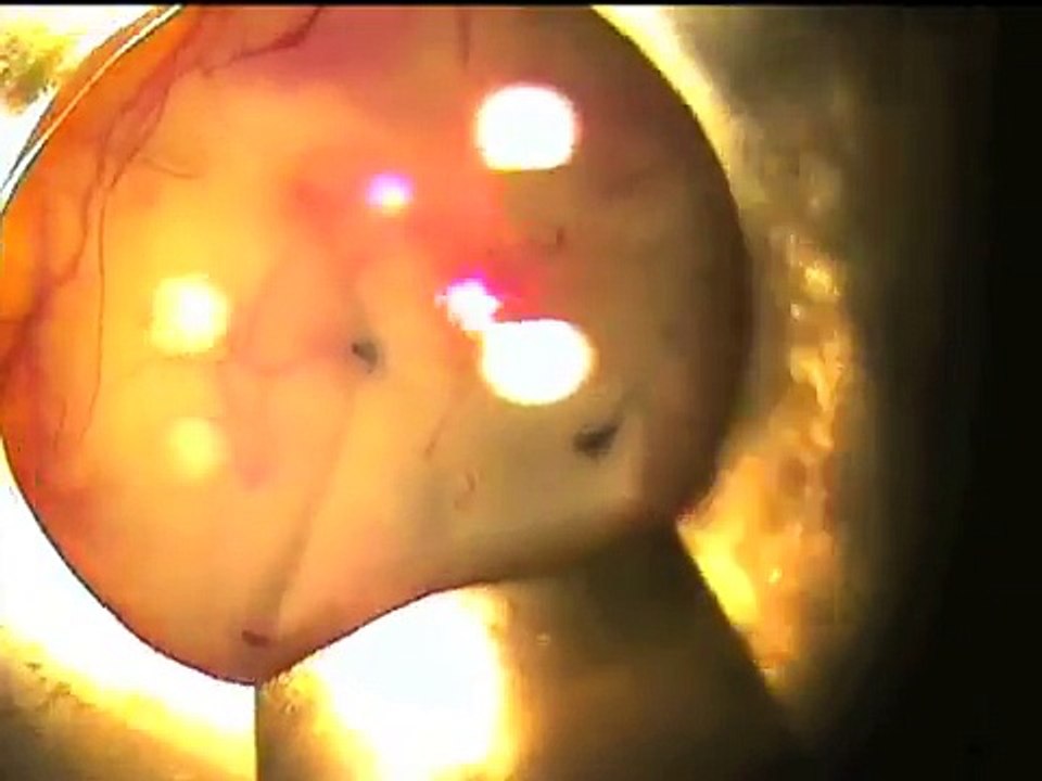 Suturolisis con láser argon en cirugía de glaucoma