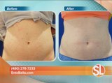 EnteBella gives you the face and body you deserve without risks of surgery