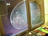 Mamografía Digital Directa