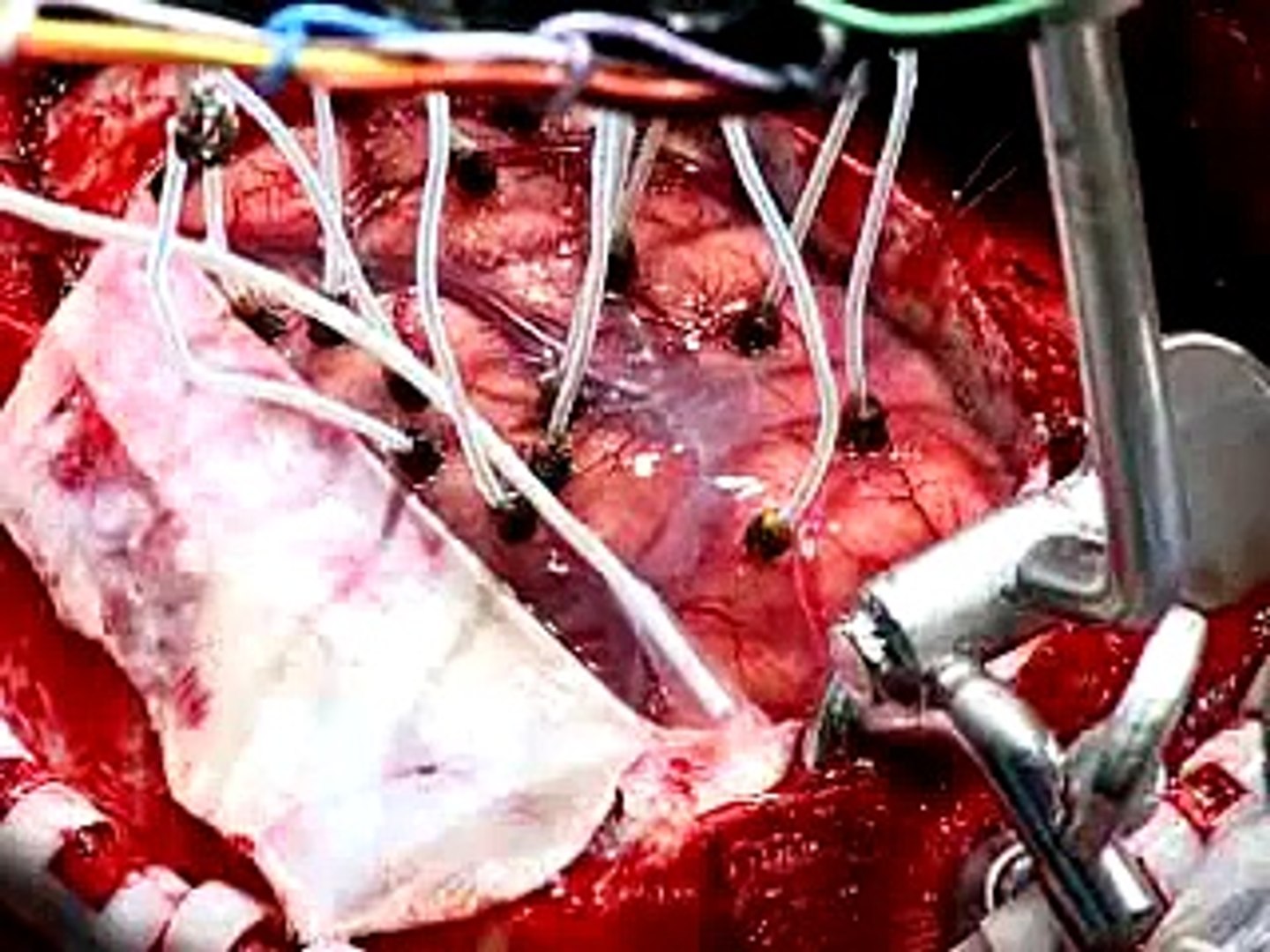 Live Webcast: Brain Surgery -Right Frontal Craniotomy - video Dailymotion
