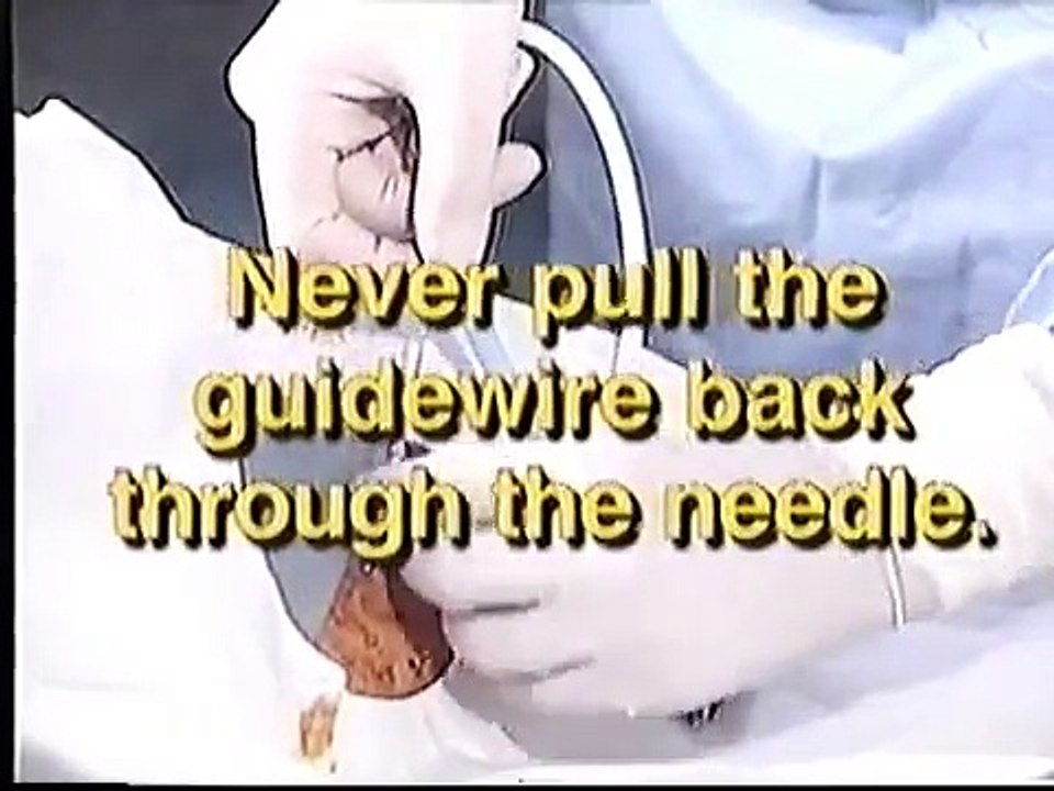 Hemodialysis catheter insertion by Quinton video Dailymotion
