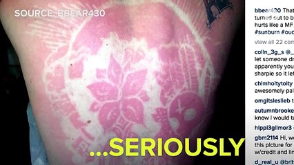 People Are Giving Themselves Artsy, Dangerous Sunburns