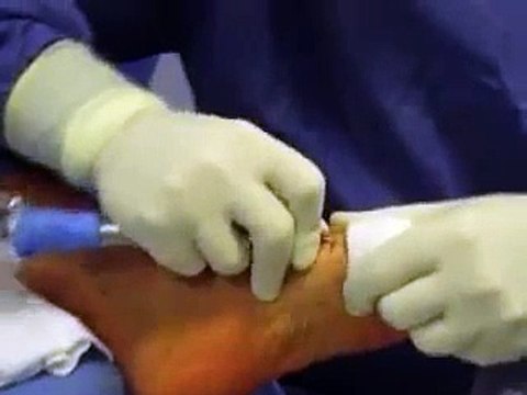 Traitement hallux valgus, metatarsalgie, orteils en griffe