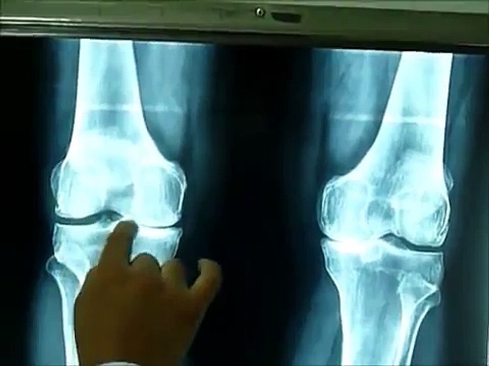 PLASMA RICO EN PLAQUETAS tratamiento para la rodilla. Dr. Edgar Mattos. CAMARA HIPERBARICA LIMA-PERU