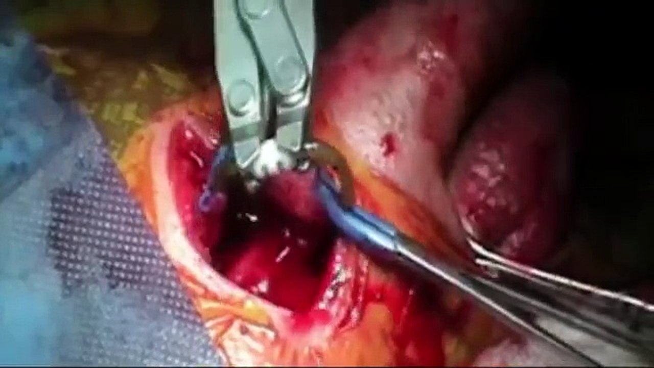 Orchidopessi Testicolo ritenuto Dott Gabriele Antonini ...