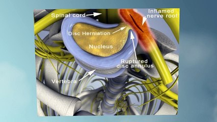 Doylestown PA Chiropractor offers alternatives to back surgery