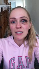 26yo Irish woman hit during domestic abuse assault