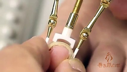 Bloc correcteur d'ongle incarné - Très douloureux!!!!