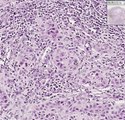 Histopathology Skin--Squamous cell carcinoma