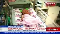 Miracle conjoined twins die shy of three weeks | Baby with two faces dies