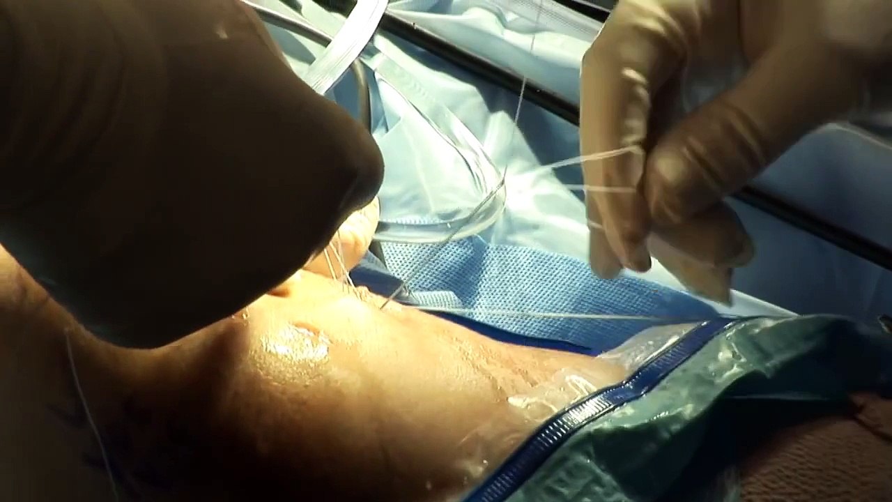 ACL Reconstruction Surgery & Medial Meniscus Repair - Dr. David Mack