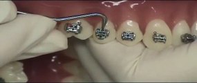 Forestadent Quick Brackets - Remoción y cambio del clip sobre tipodonto (Brackets autoligables)