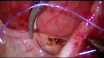 Demonstration of haptic-enhanced minimally invasive surgery techniques