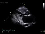 Echocardiography to Assess Mitral-Valve Leaflets.