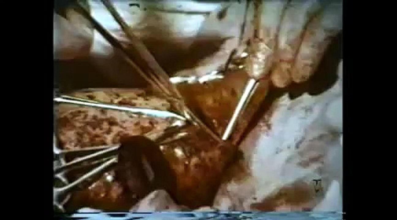 Army Medicine In Vietnam part 3 WARNING GRAPHIC WAR FOOTAGE