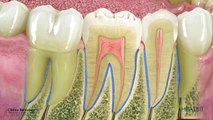 Periodoncia - gingivitis y periodontitis o 
